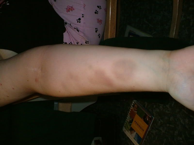 bruises1